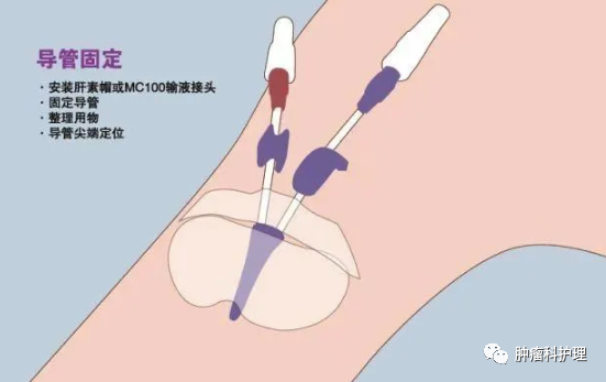 双腔cvc怎么开关双腔中心静脉导管：主管副管傻傻分不清楚，今天说个明白_https://www.jmylbn.com_新闻资讯_第2张