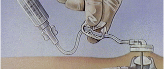 输液港抽不出回血，怎么办？别着急，这里有方法！