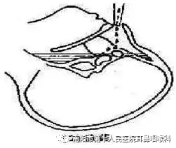 什么是负压操作鼻负压置换疗法的操作流程_https://www.jmylbn.com_新闻资讯_第9张