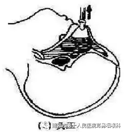 什么是负压操作鼻负压置换疗法的操作流程_https://www.jmylbn.com_新闻资讯_第10张