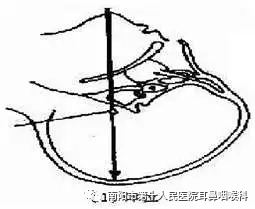 什么是负压操作鼻负压置换疗法的操作流程_https://www.jmylbn.com_新闻资讯_第8张