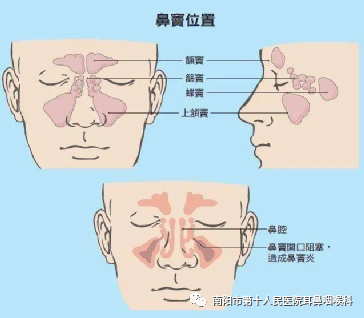 什么是负压操作鼻负压置换疗法的操作流程_https://www.jmylbn.com_新闻资讯_第4张