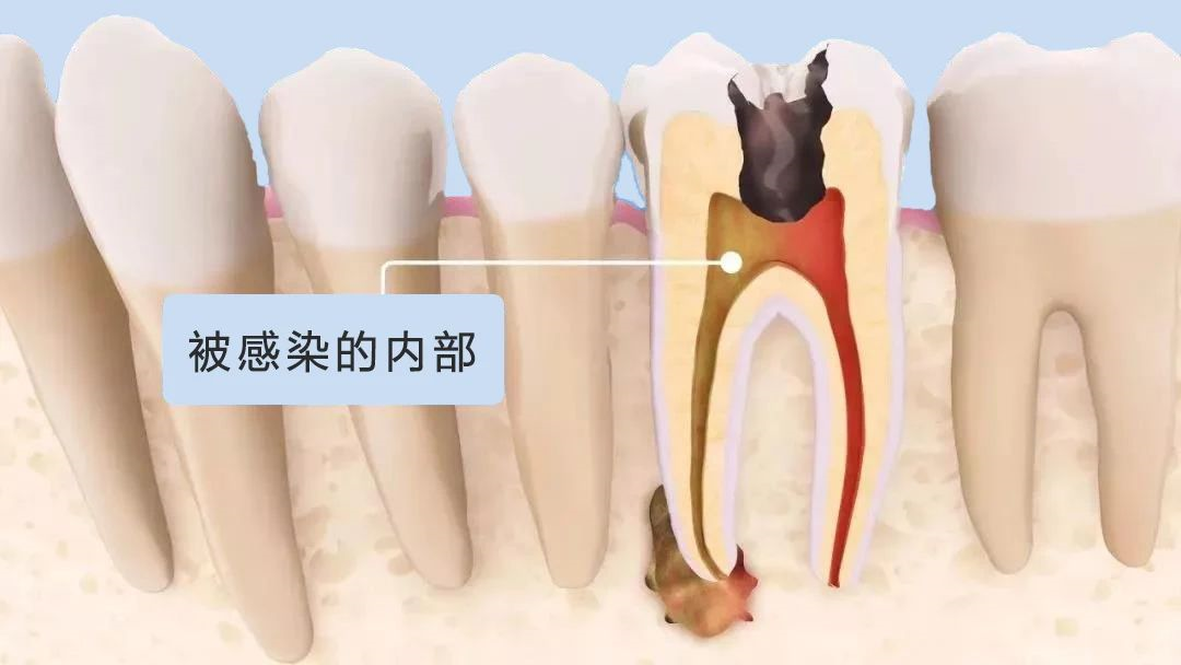 为什么要用根管马达牙痛，为啥要根管治疗？_https://www.jmylbn.com_新闻资讯_第3张