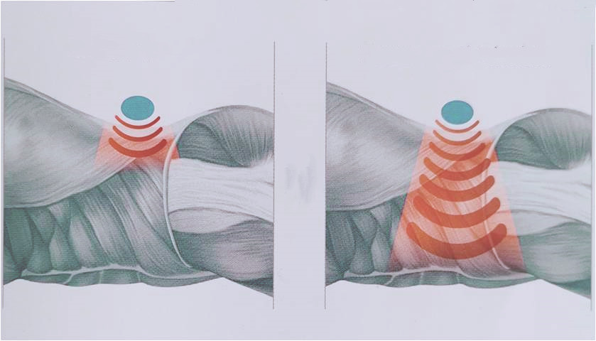 电子磁疗仪怎么用【健康园地】康复疼痛管理专家——激光磁疗来帮你！_https://www.jmylbn.com_新闻资讯_第7张