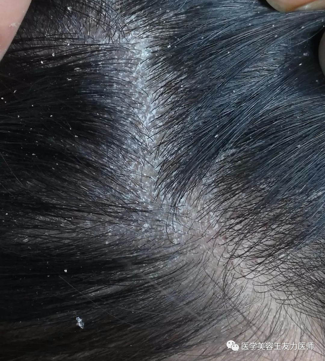 头皮屑怎么治？