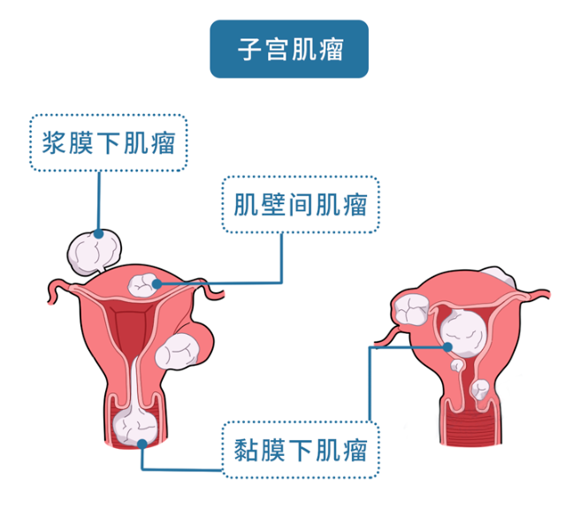 当试管婴儿碰上子宫肌瘤，试管之路该何去何从！