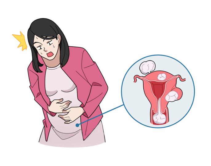 当试管婴儿碰上子宫肌瘤，试管之路该何去何从！