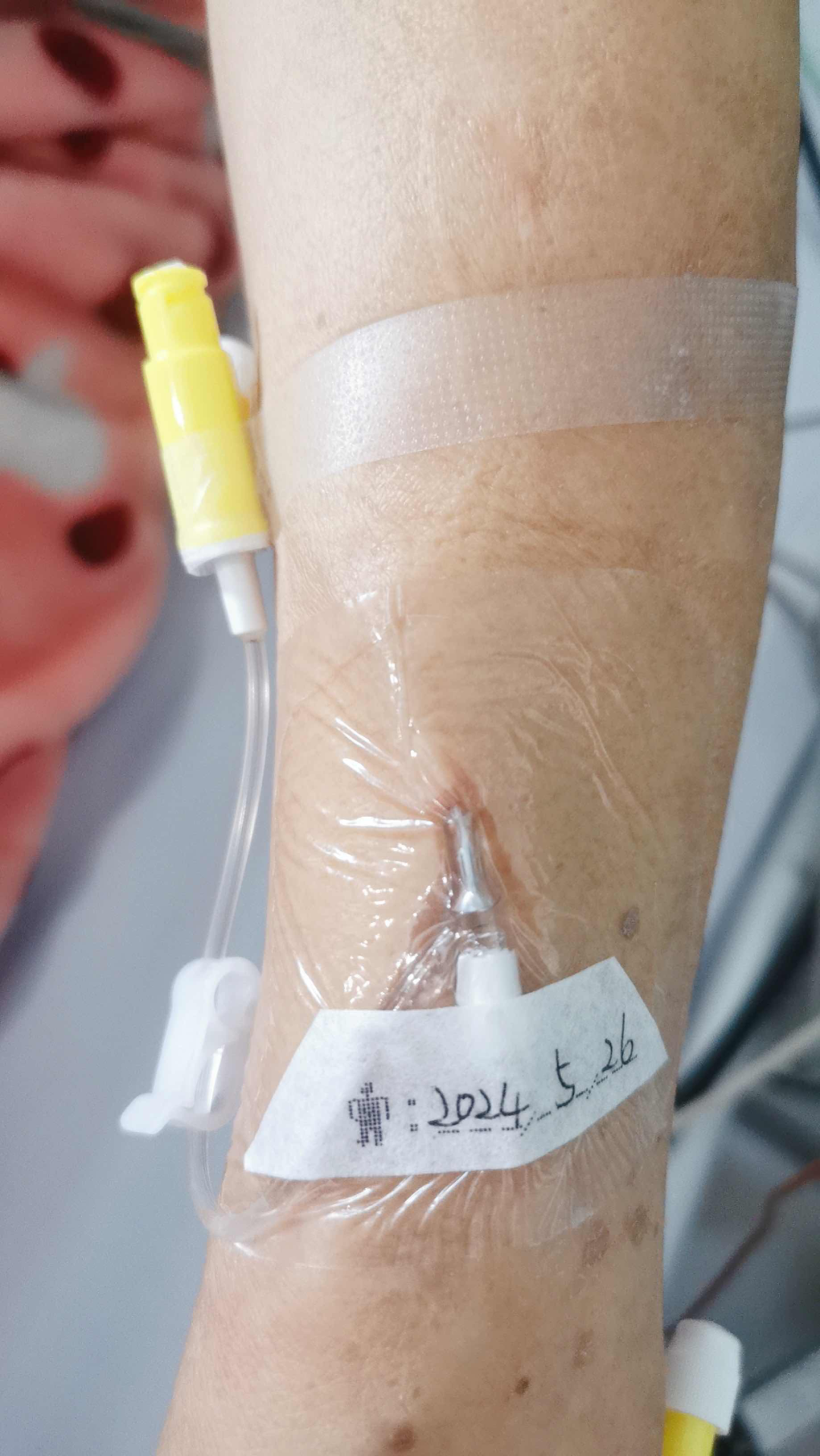 留置针怎么贴膜护士关注的留置针问题，都在这里了_https://www.jmylbn.com_新闻资讯_第4张