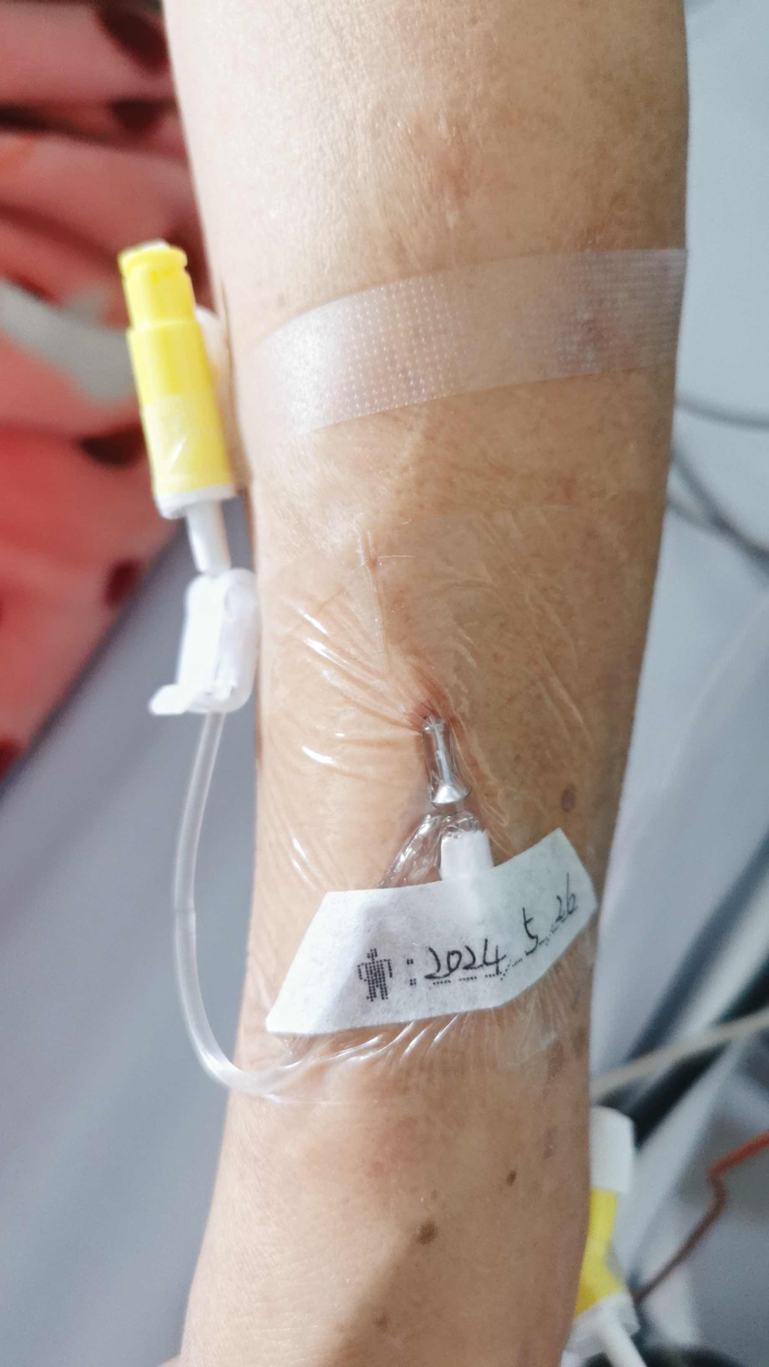 留置针怎么贴膜护士关注的留置针问题，都在这里了_https://www.jmylbn.com_新闻资讯_第3张