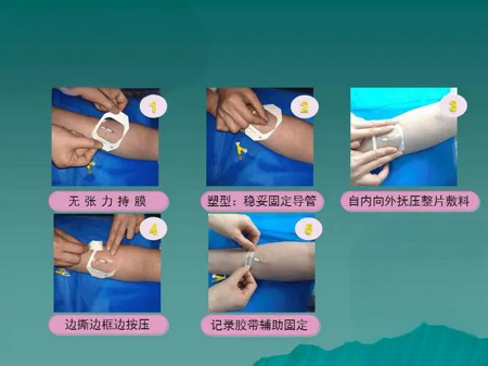 留置针怎么贴膜护士关注的留置针问题，都在这里了_https://www.jmylbn.com_新闻资讯_第6张