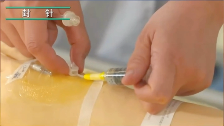 留置针怎么贴膜护士关注的留置针问题，都在这里了_https://www.jmylbn.com_新闻资讯_第2张