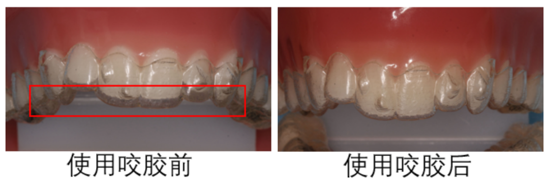 牙科材料硅胶怎么用【口腔科普】“小小咬胶”却是隐形矫治的助力神器！_https://www.jmylbn.com_新闻资讯_第6张