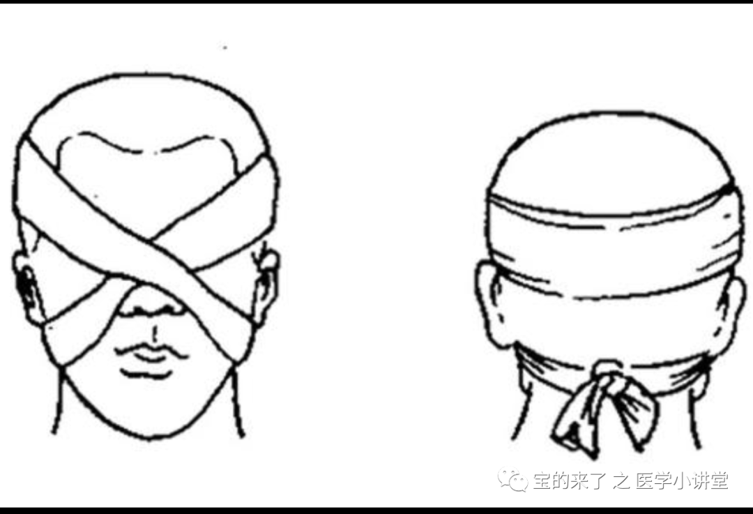 医用纱布绷带怎么绑急救知识 ｜ 绷带及三角巾包扎法_https://www.jmylbn.com_新闻资讯_第17张