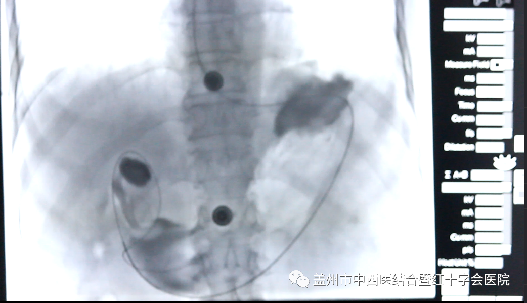 什么是外周介入外周血管介入是什么？治疗什么疾病？一次给你讲清楚_https://www.jmylbn.com_新闻资讯_第6张