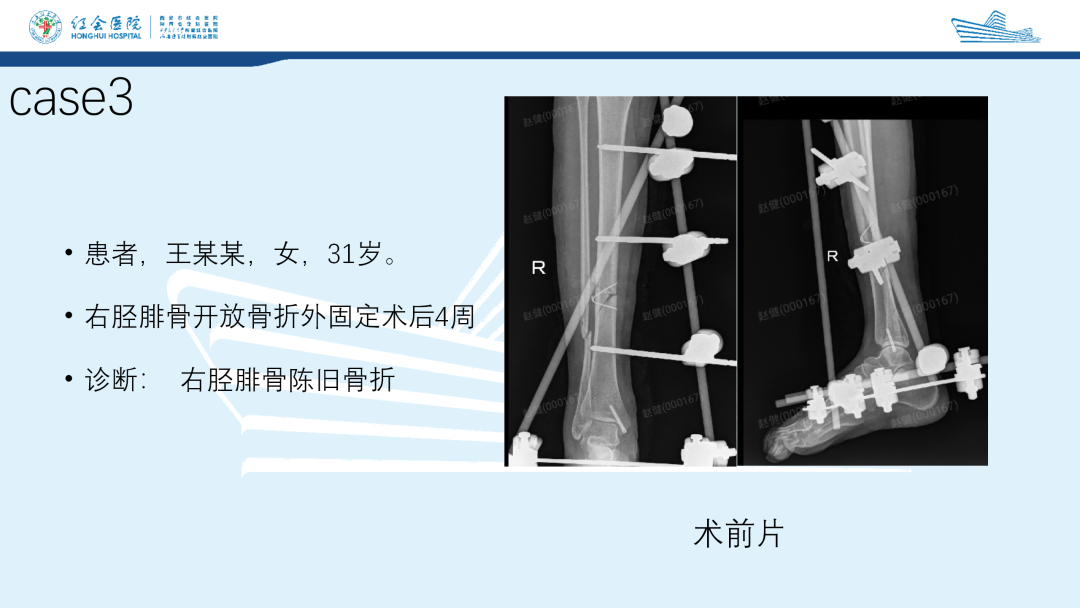 髌旁外侧入路胫骨髓内钉的临床应用
