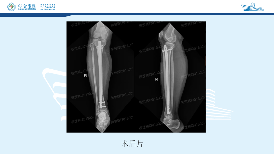 髌旁外侧入路胫骨髓内钉的临床应用