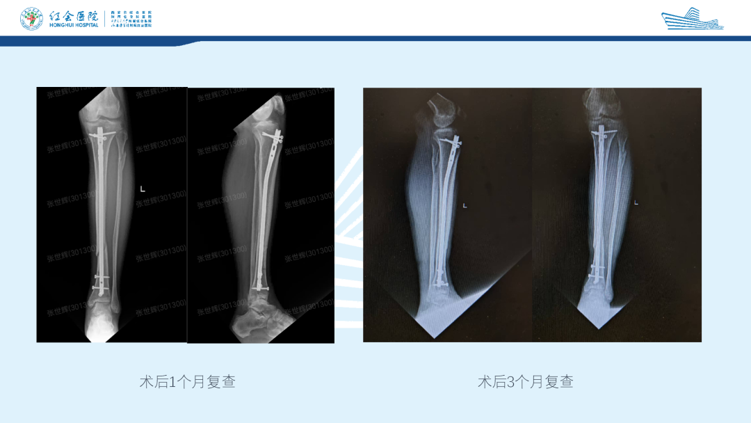 髌旁外侧入路胫骨髓内钉的临床应用