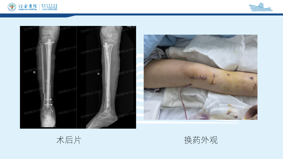 髌旁外侧入路胫骨髓内钉的临床应用