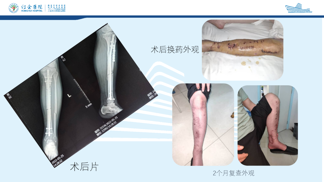 髌旁外侧入路胫骨髓内钉的临床应用