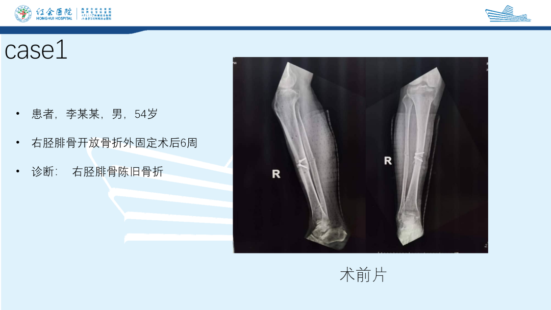 髌旁外侧入路胫骨髓内钉的临床应用