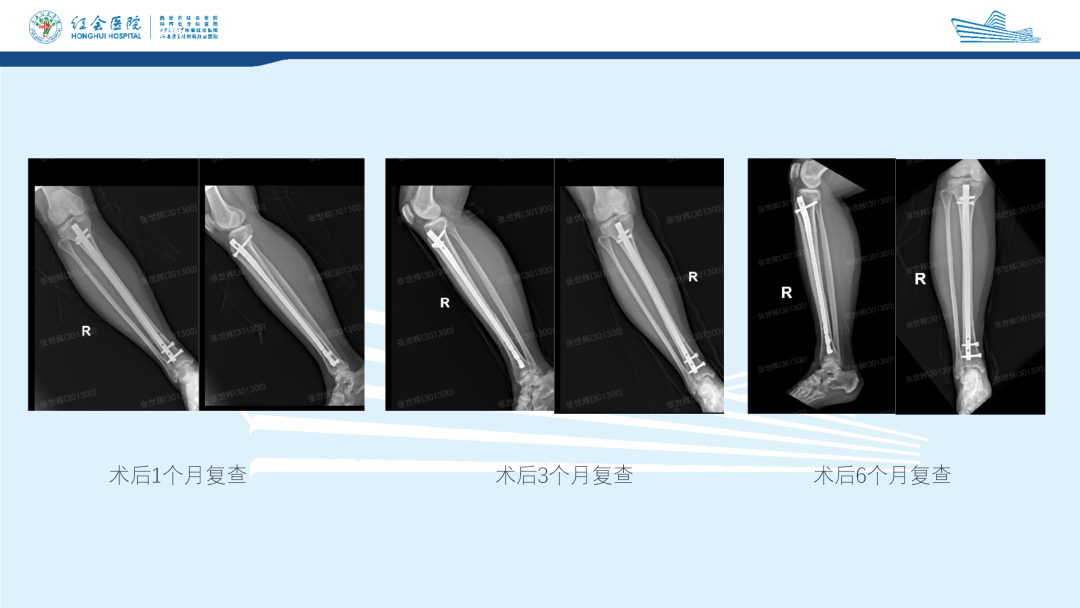 髌旁外侧入路胫骨髓内钉的临床应用