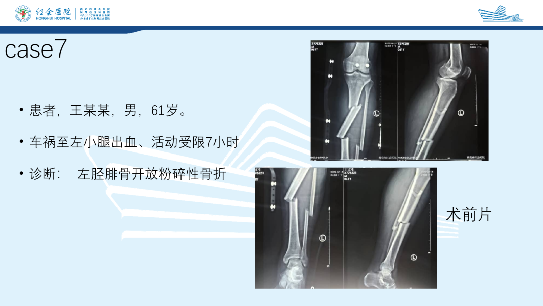 髌旁外侧入路胫骨髓内钉的临床应用