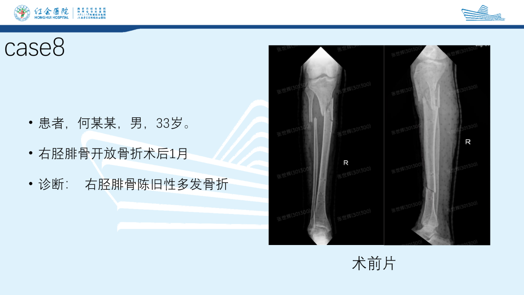 髌旁外侧入路胫骨髓内钉的临床应用