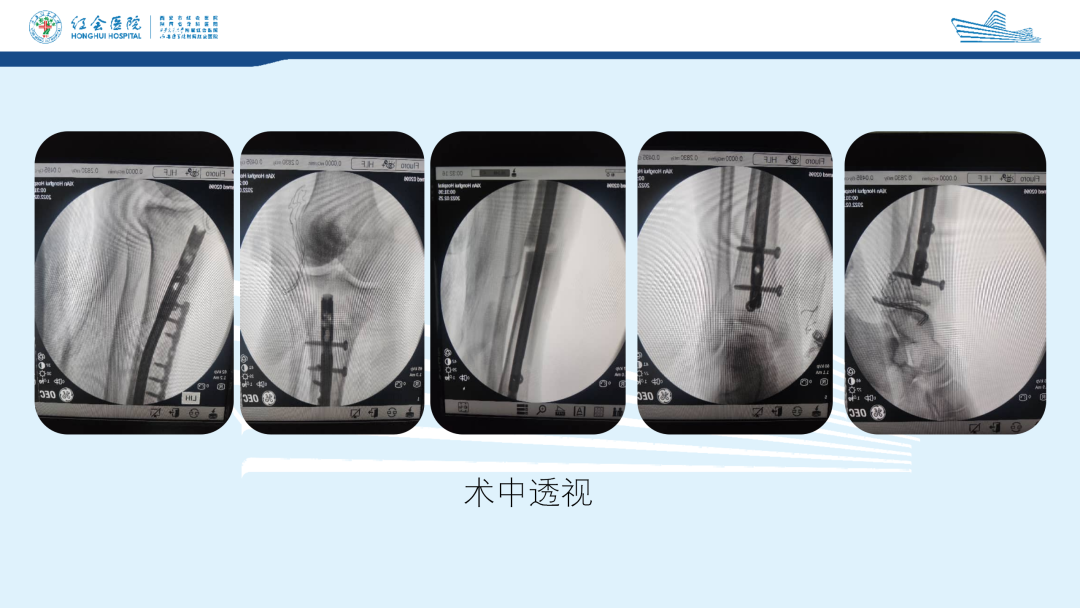 髌旁外侧入路胫骨髓内钉的临床应用