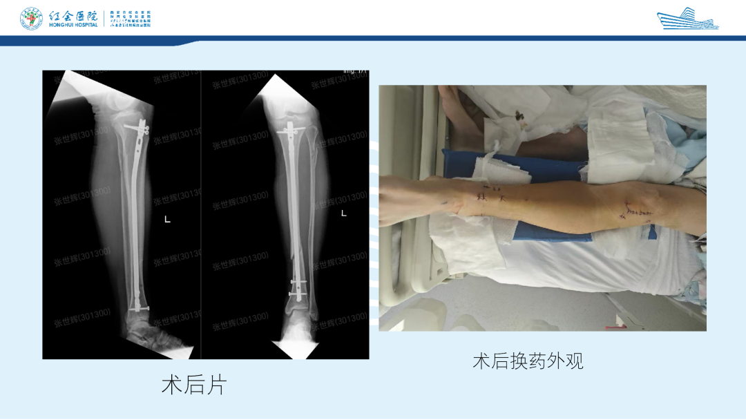 髌旁外侧入路胫骨髓内钉的临床应用