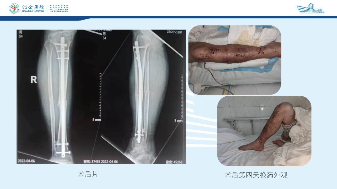 髌旁外侧入路胫骨髓内钉的临床应用