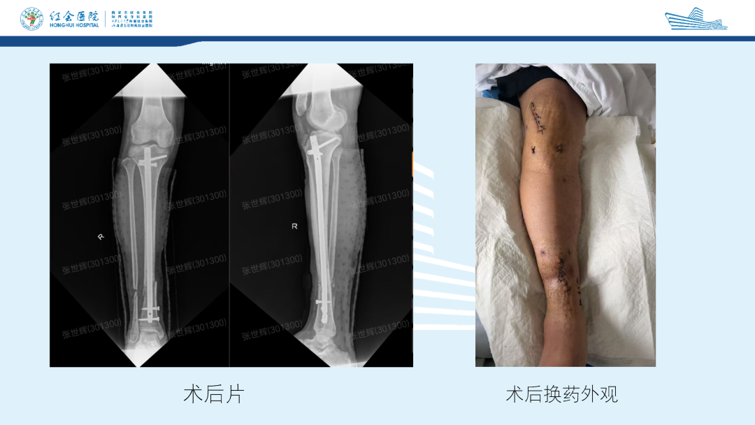 髌旁外侧入路胫骨髓内钉的临床应用