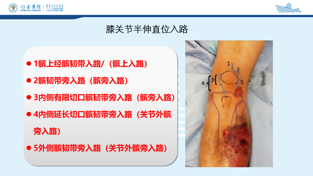 髌旁外侧入路胫骨髓内钉的临床应用