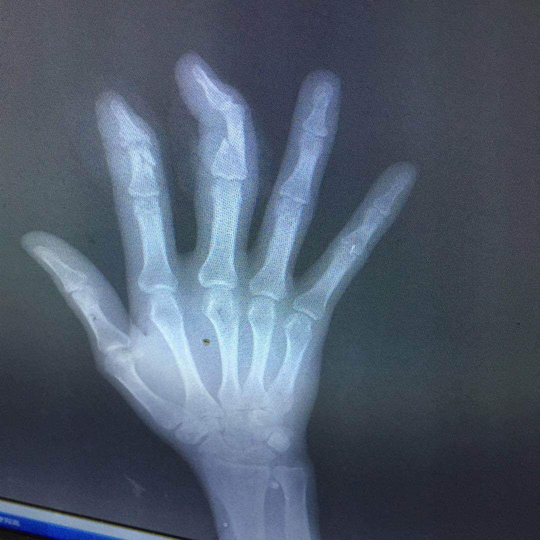 患者口述——工作中“老马失蹄”，我的受伤经历和住院感受