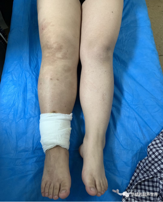 超声典型病例 Klippel Trenanuay综合征 华斌的超声世界 二十次幂