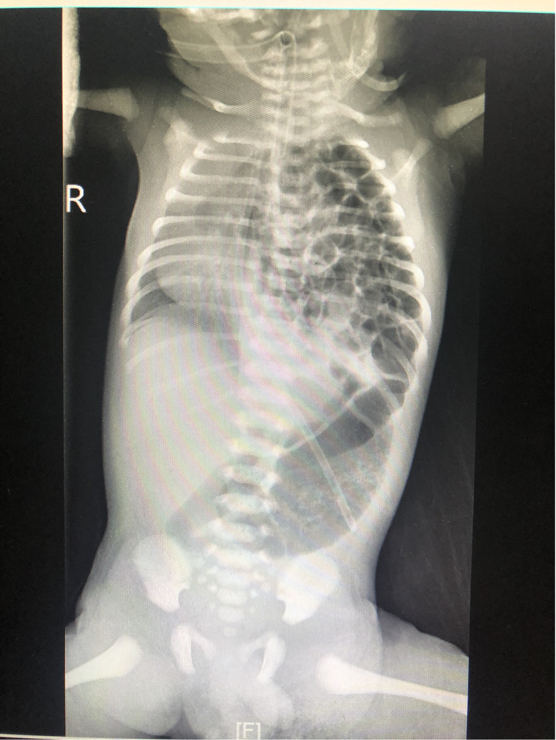 什么是Acdh【儿科麻醉】先天性膈疝CDH_https://www.jmylbn.com_新闻资讯_第2张