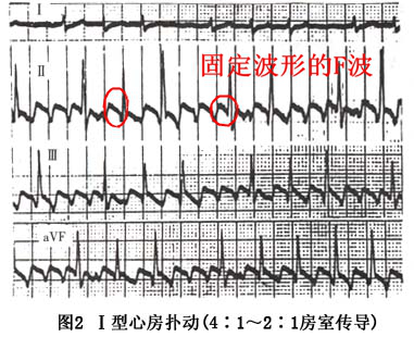 什么是同步心电图心电图学不会、记不住？这个合集very good！_https://www.jmylbn.com_新闻资讯_第21张