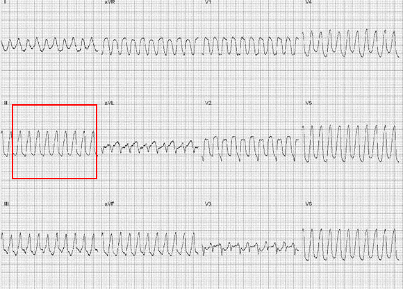 什么是同步心电图心电图学不会、记不住？这个合集very good！_https://www.jmylbn.com_新闻资讯_第29张