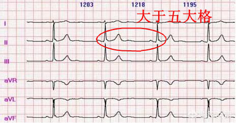 什么是同步心电图心电图学不会、记不住？这个合集very good！_https://www.jmylbn.com_新闻资讯_第11张