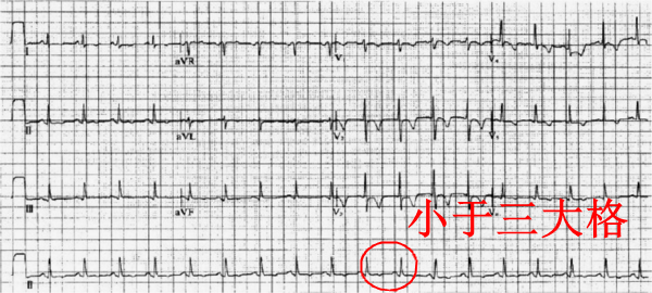 什么是同步心电图心电图学不会、记不住？这个合集very good！_https://www.jmylbn.com_新闻资讯_第9张