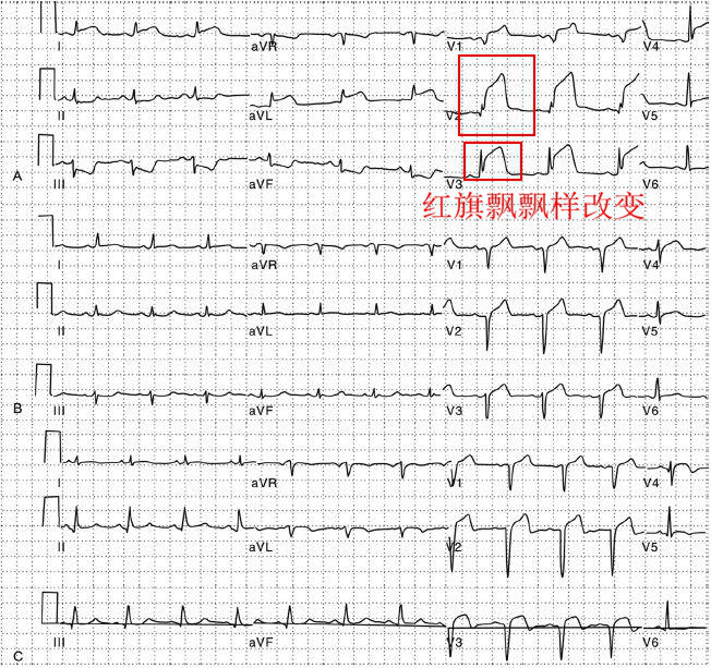 什么是同步心电图心电图学不会、记不住？这个合集very good！_https://www.jmylbn.com_新闻资讯_第34张