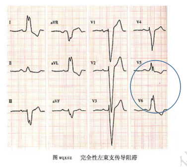 什么是同步心电图心电图学不会、记不住？这个合集very good！_https://www.jmylbn.com_新闻资讯_第15张