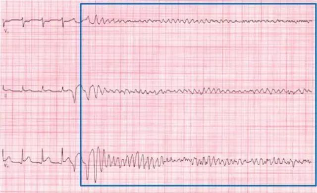什么是同步心电图心电图学不会、记不住？这个合集very good！_https://www.jmylbn.com_新闻资讯_第31张