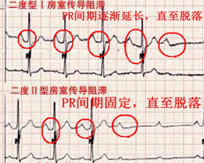 什么是同步心电图心电图学不会、记不住？这个合集very good！_https://www.jmylbn.com_新闻资讯_第17张