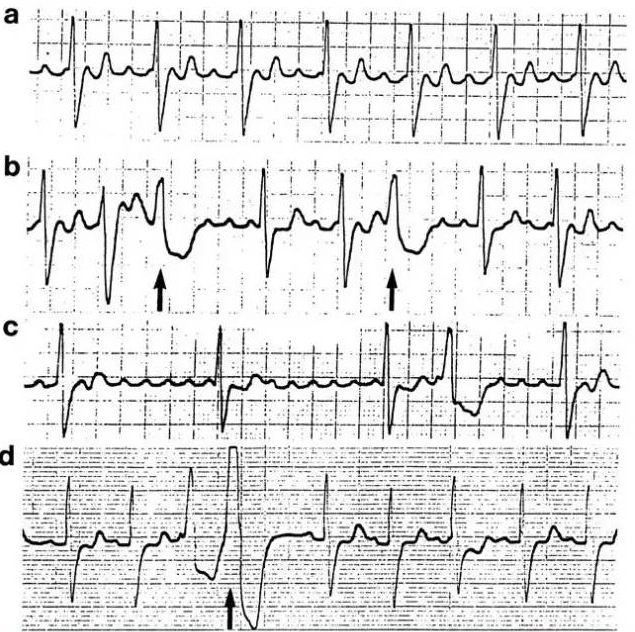 什么是同步心电图心电图学不会、记不住？这个合集very good！_https://www.jmylbn.com_新闻资讯_第25张