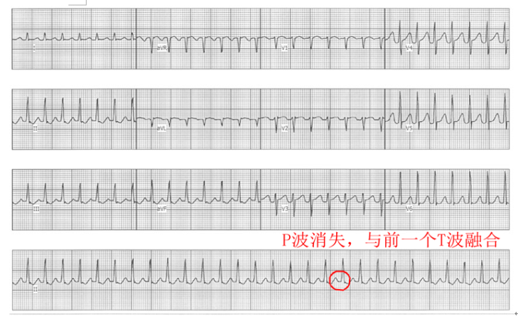 什么是同步心电图心电图学不会、记不住？这个合集very good！_https://www.jmylbn.com_新闻资讯_第13张
