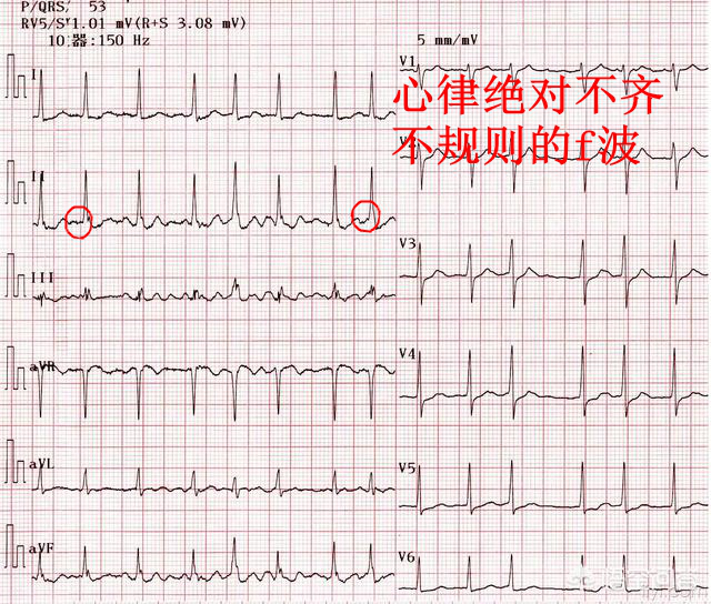 什么是同步心电图心电图学不会、记不住？这个合集very good！_https://www.jmylbn.com_新闻资讯_第23张