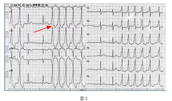 什么是同步心电图心电图学不会、记不住？这个合集very good！_https://www.jmylbn.com_新闻资讯_第27张