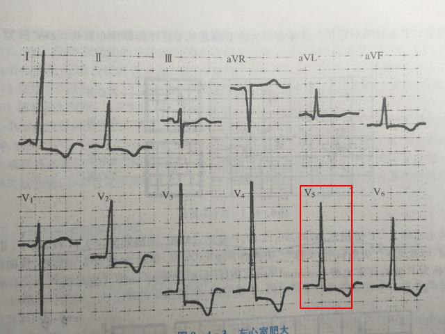 什么是同步心电图心电图学不会、记不住？这个合集very good！_https://www.jmylbn.com_新闻资讯_第36张