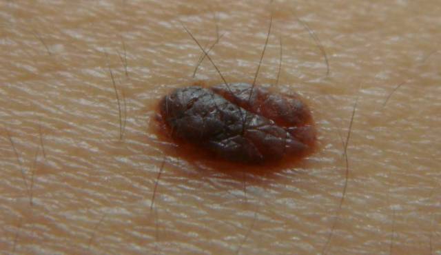 是皮下脂肪组织的瘤状物, 由分化良好的脂肪组织增生引起的良性肿瘤