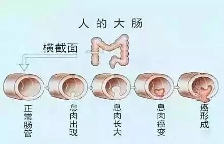 健康科普 | 大肠息肉来者不善，可能变成癌？